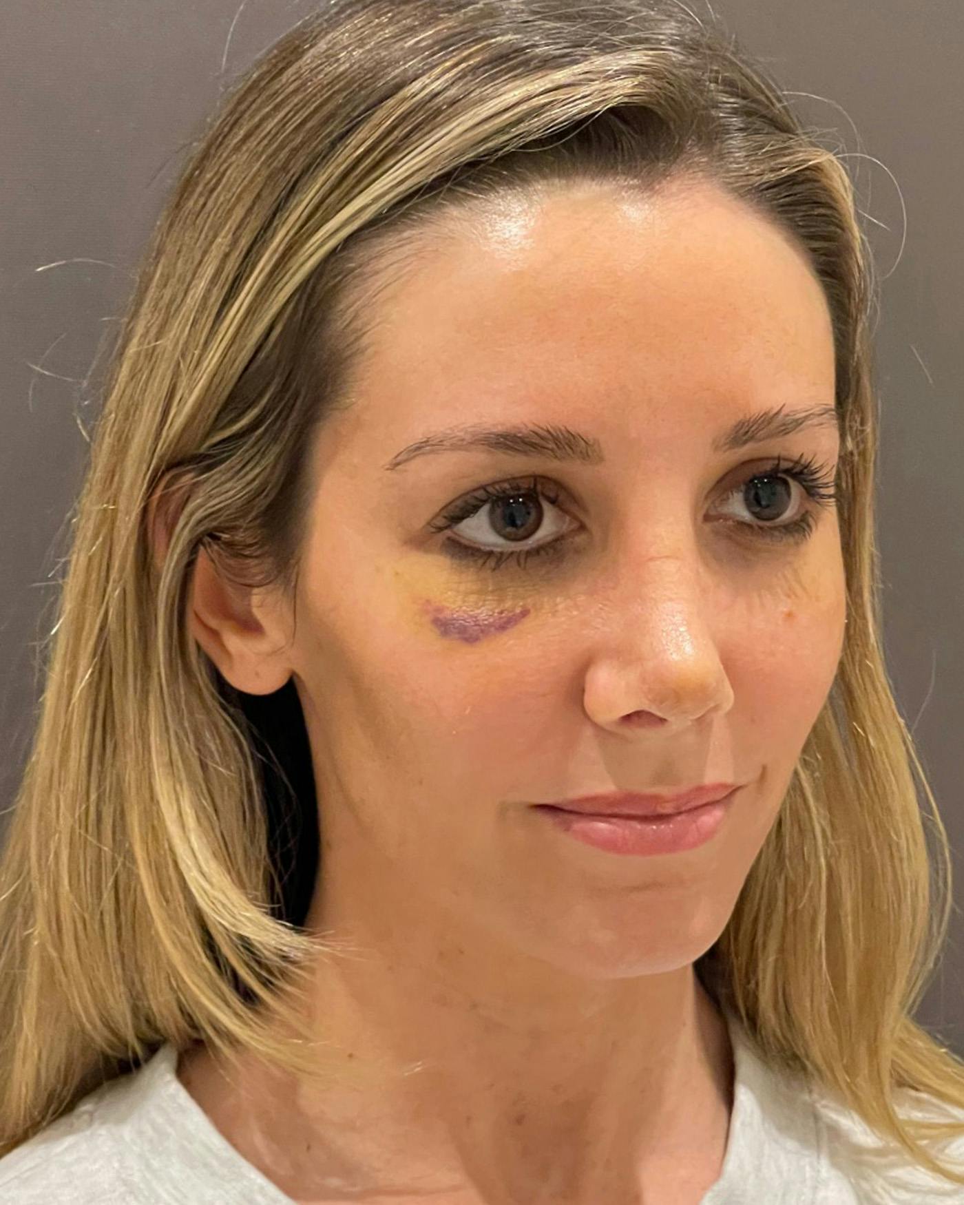 Rhinoplasty Before & After Gallery - Patient 263581 - Image 8