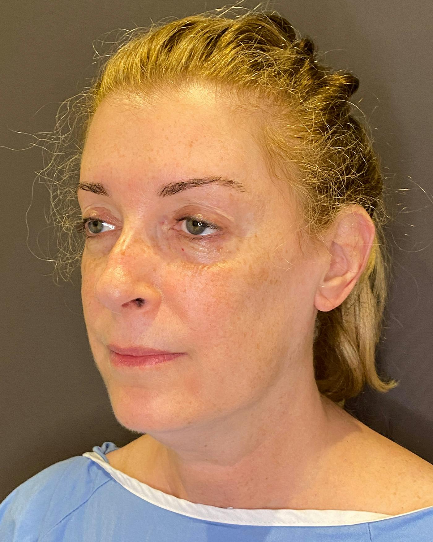 Top Surgery Before & After Gallery - Patient 149616 - Image 7