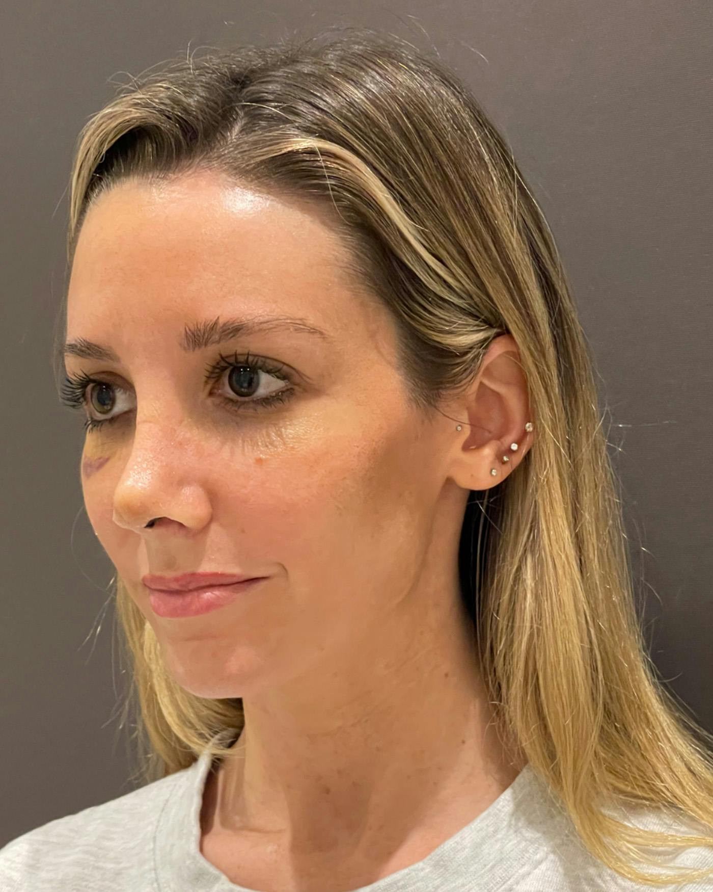 Rhinoplasty Before & After Gallery - Patient 263581 - Image 10