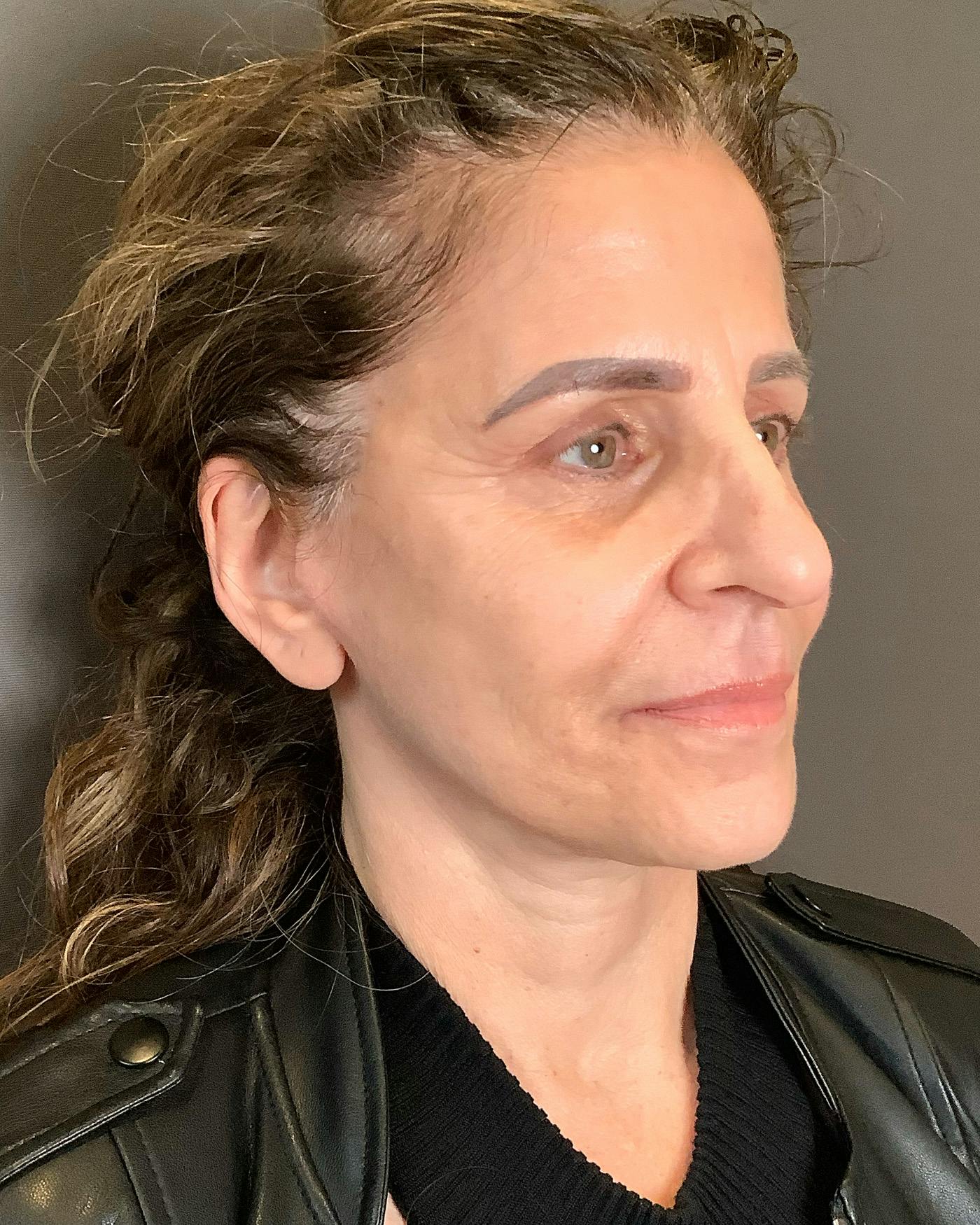 Facelifts / Necklift Before & After Gallery - Patient 208221 - Image 2