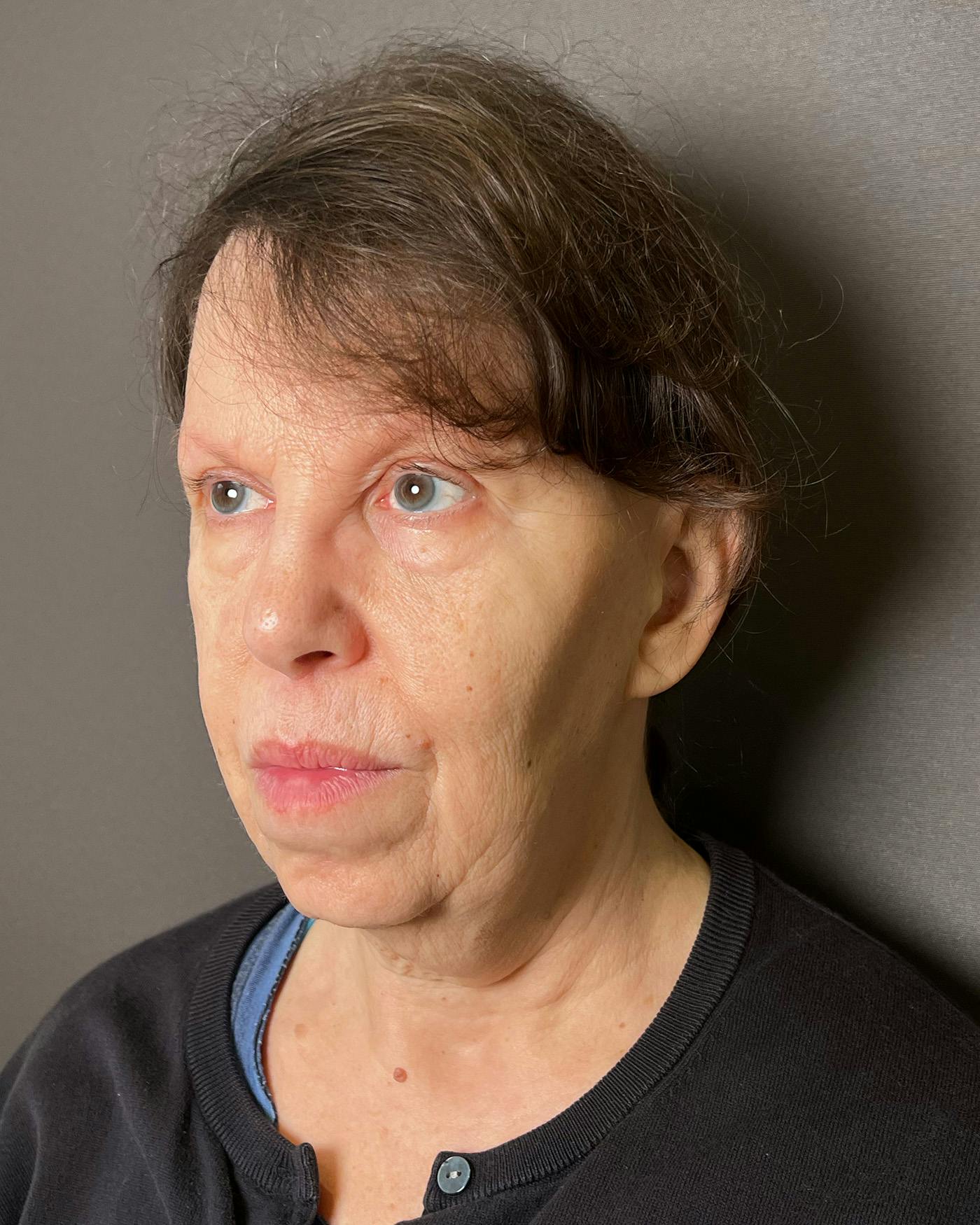 Facelifts / Necklift Before & After Gallery - Patient 183402 - Image 5
