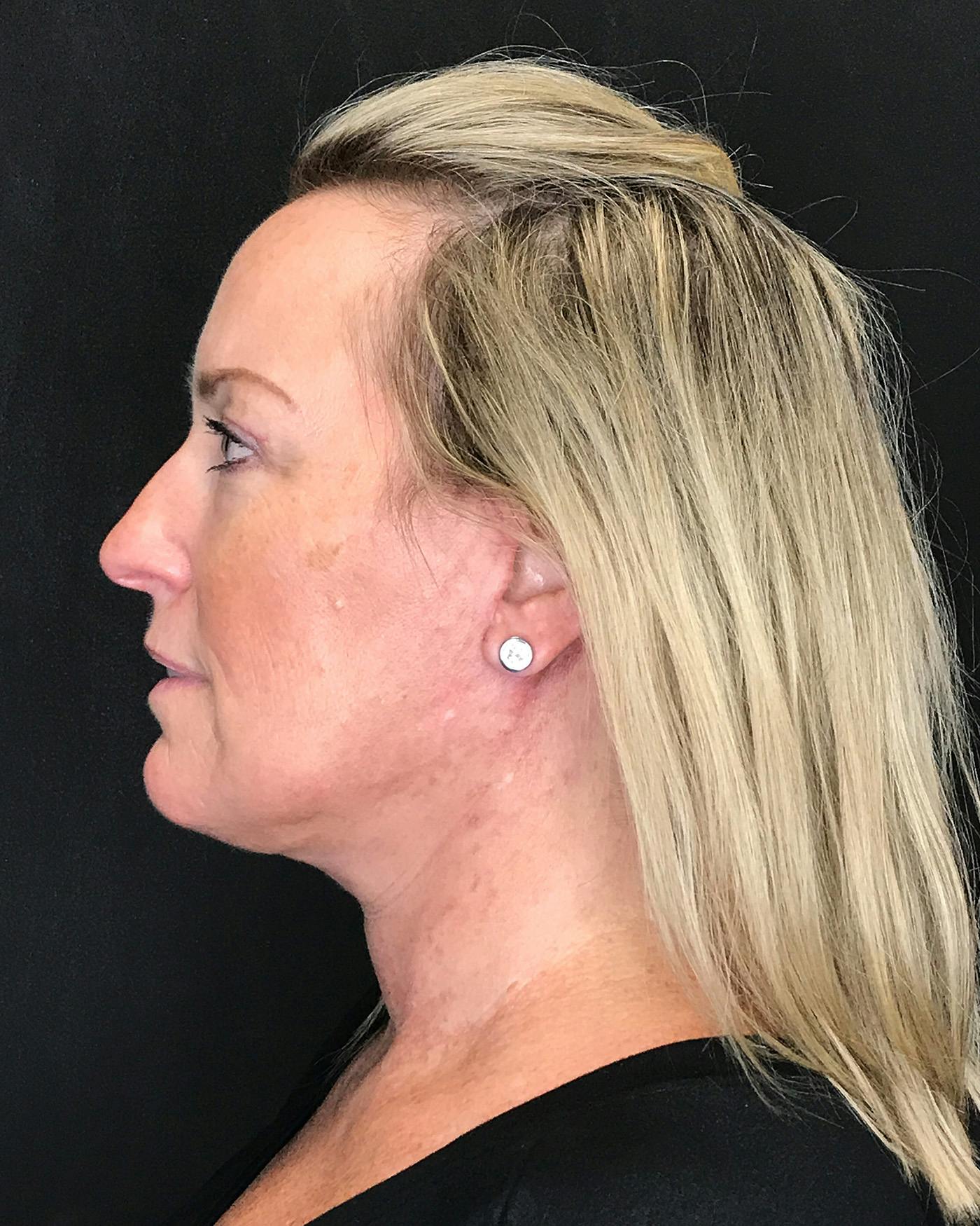 Facelifts / Necklift Before & After Gallery - Patient 286332 - Image 6