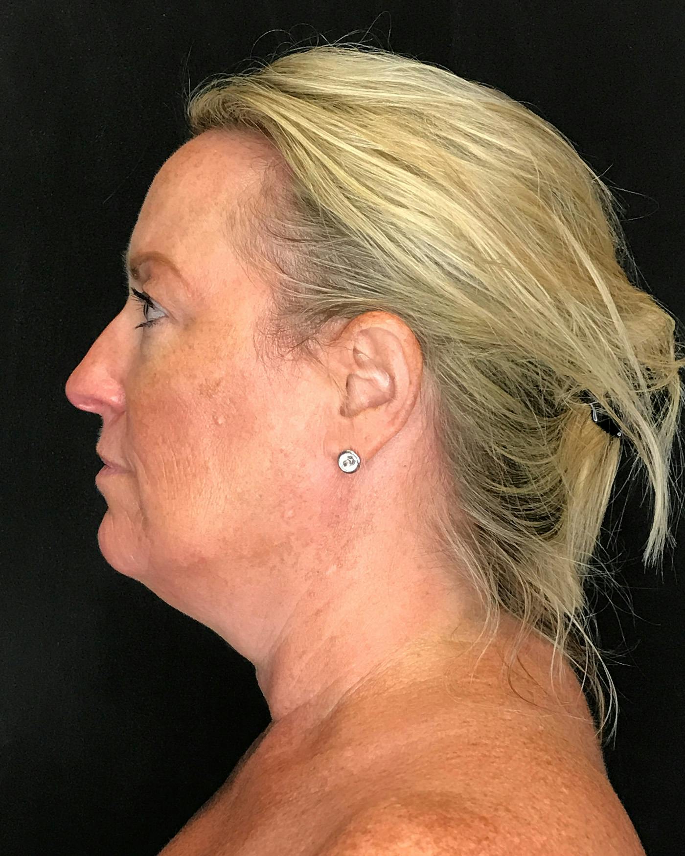 Facelifts / Necklift Before & After Gallery - Patient 286332 - Image 5