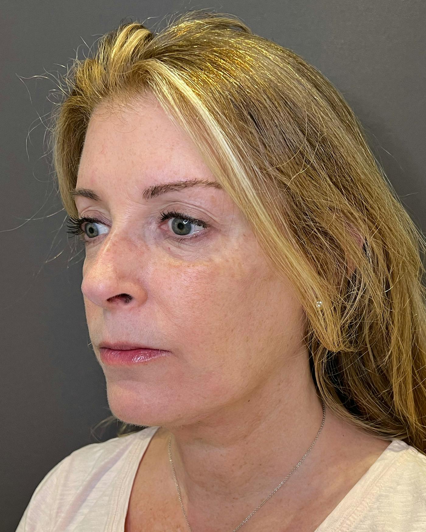 Top Surgery Before & After Gallery - Patient 149616 - Image 8