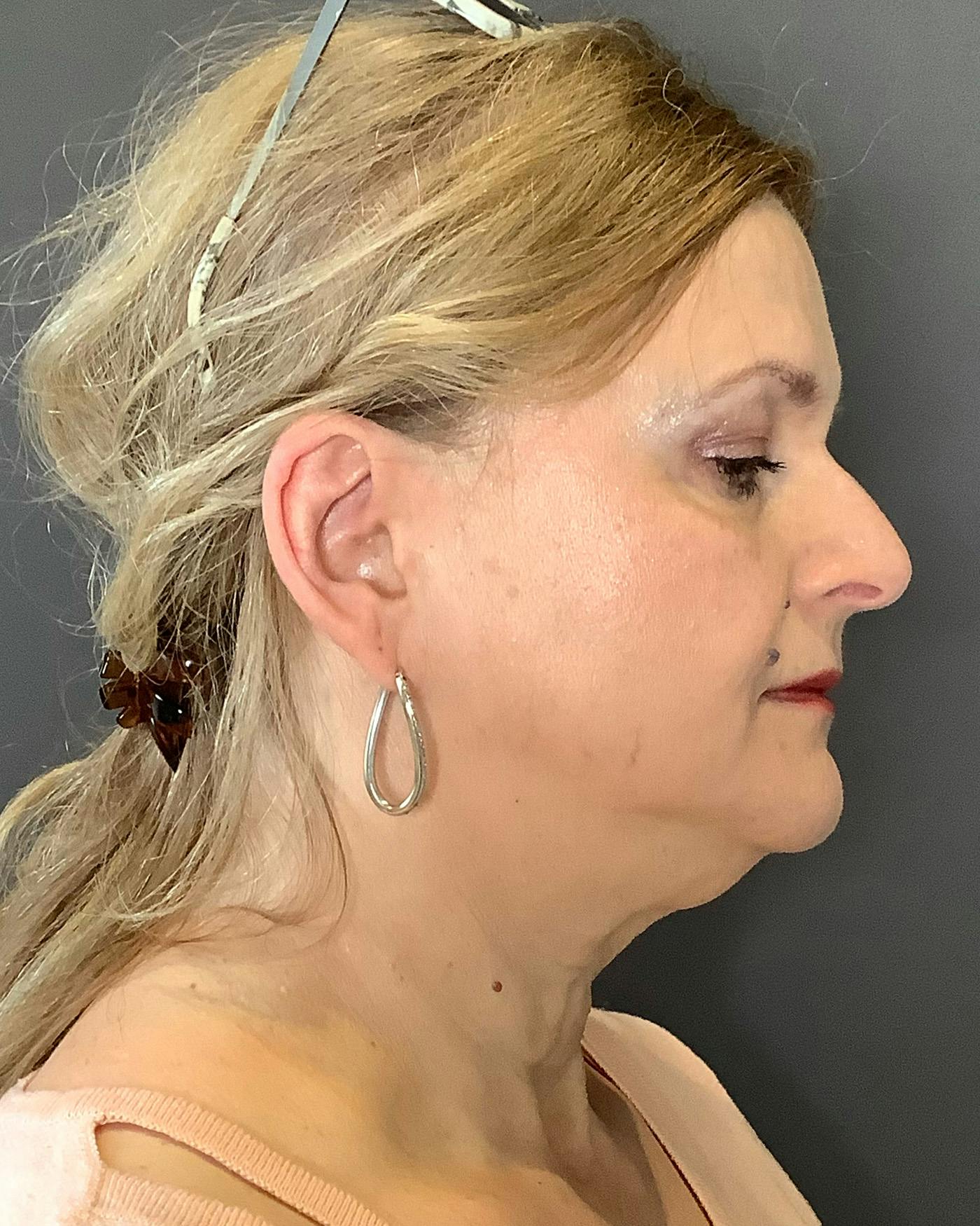 Facelifts / Necklift Before & After Gallery - Patient 737281 - Image 3