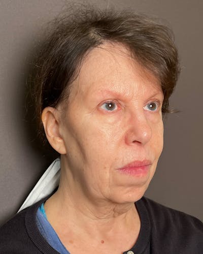 Facelifts / Necklift Before & After Gallery - Patient 183402 - Image 1