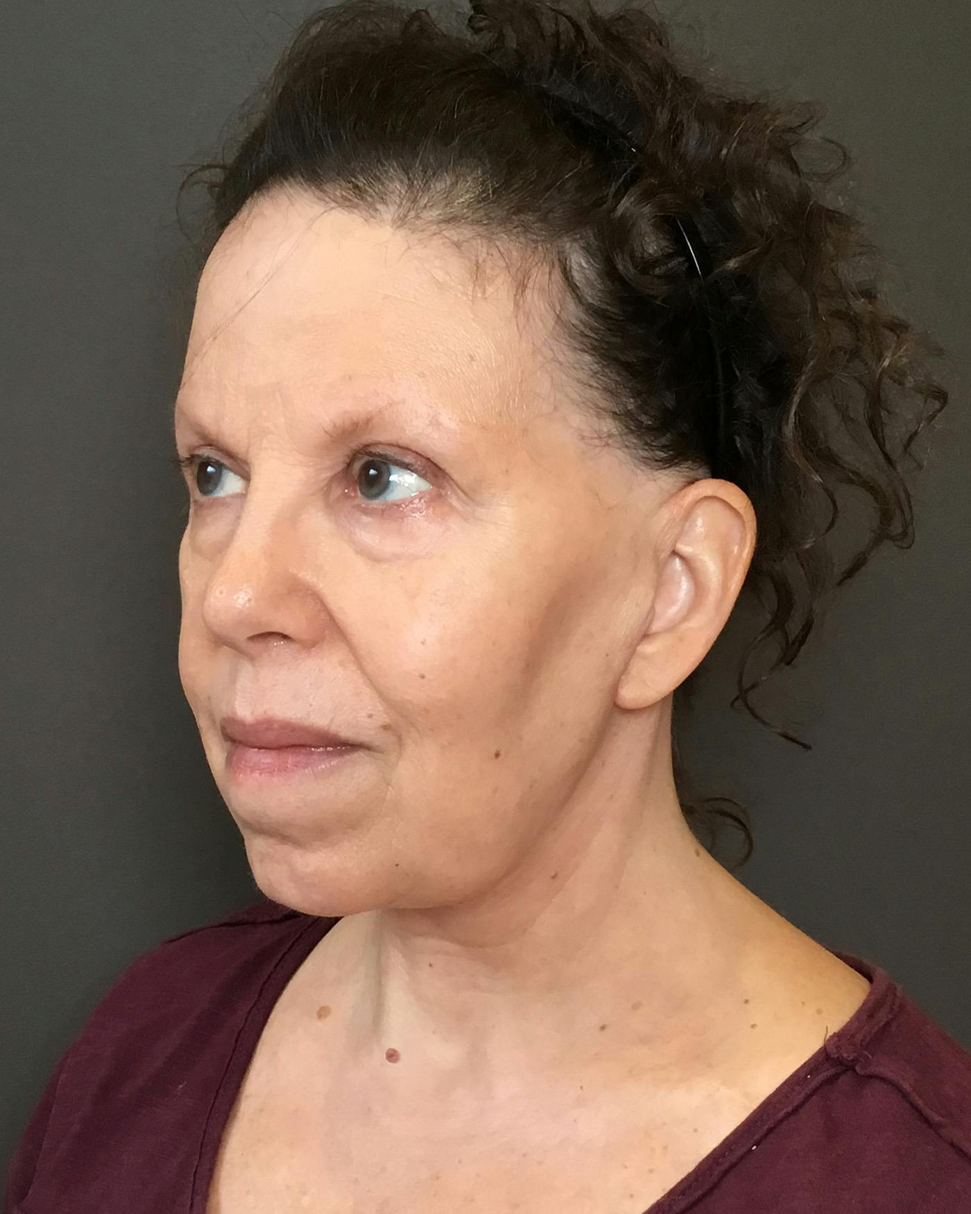 Facelifts / Necklift Before & After Gallery - Patient 183402 - Image 6