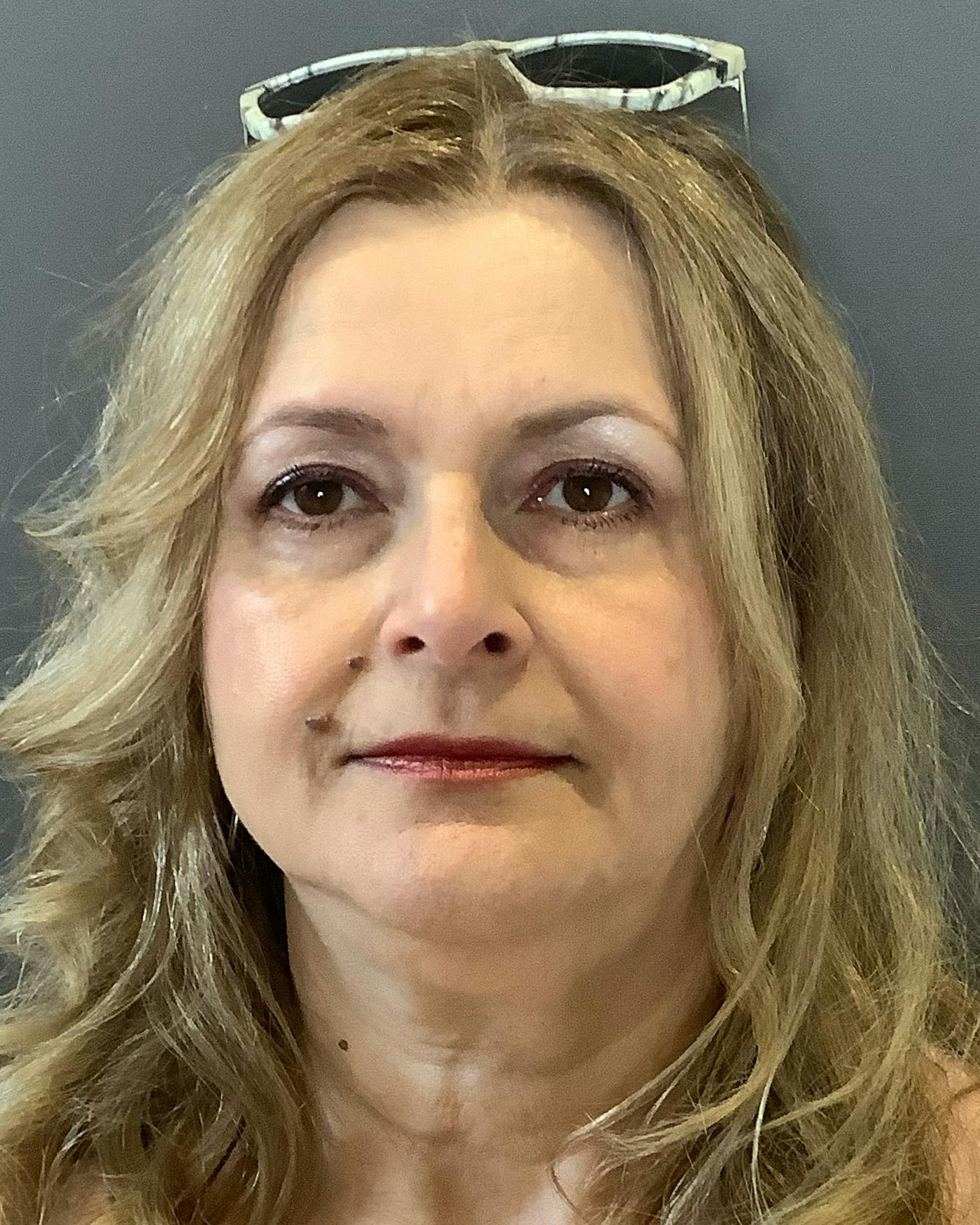 Facelifts / Necklift Before & After Gallery - Patient 737281 - Image 5