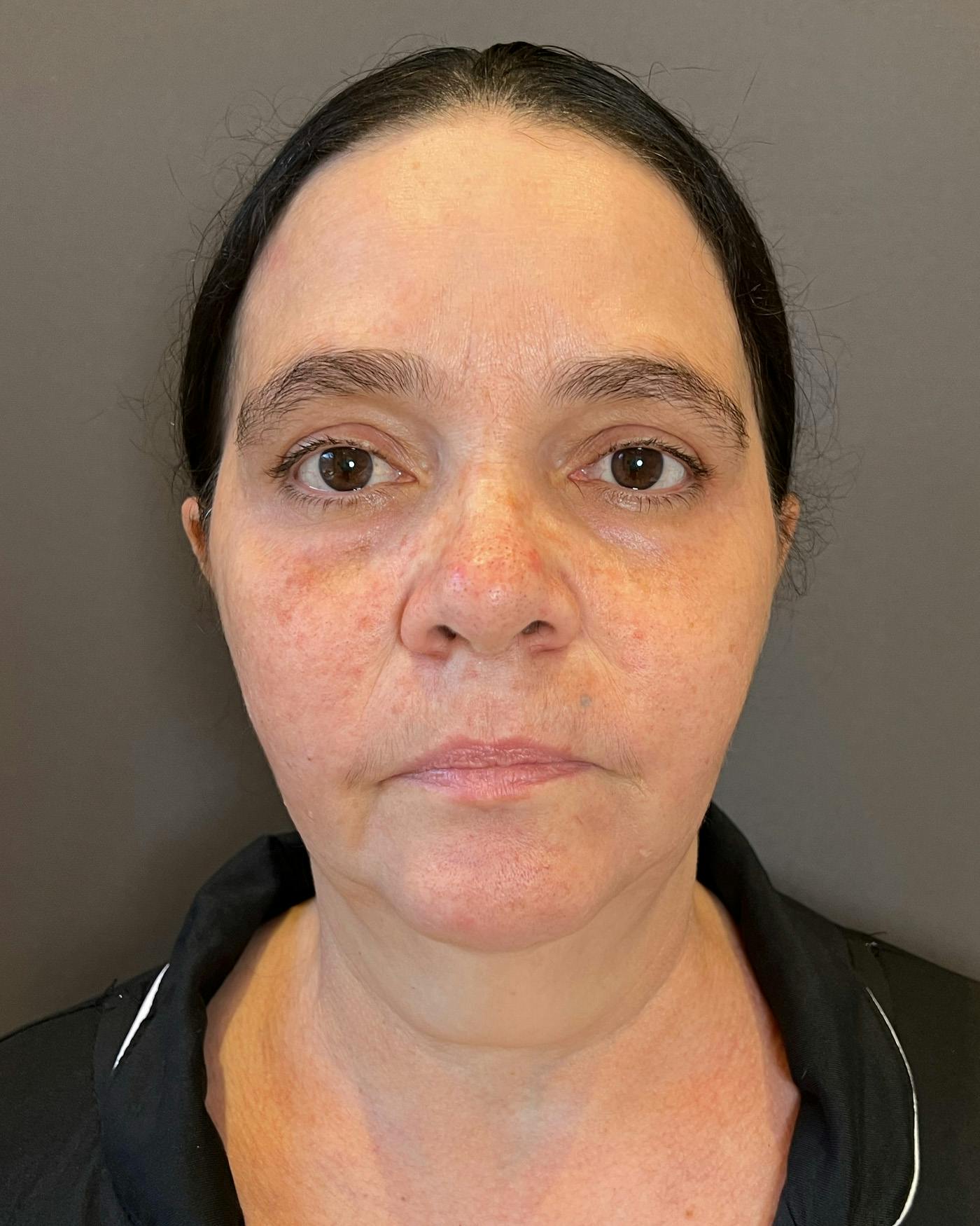Facelifts / Necklift Before & After Gallery - Patient 754198 - Image 3