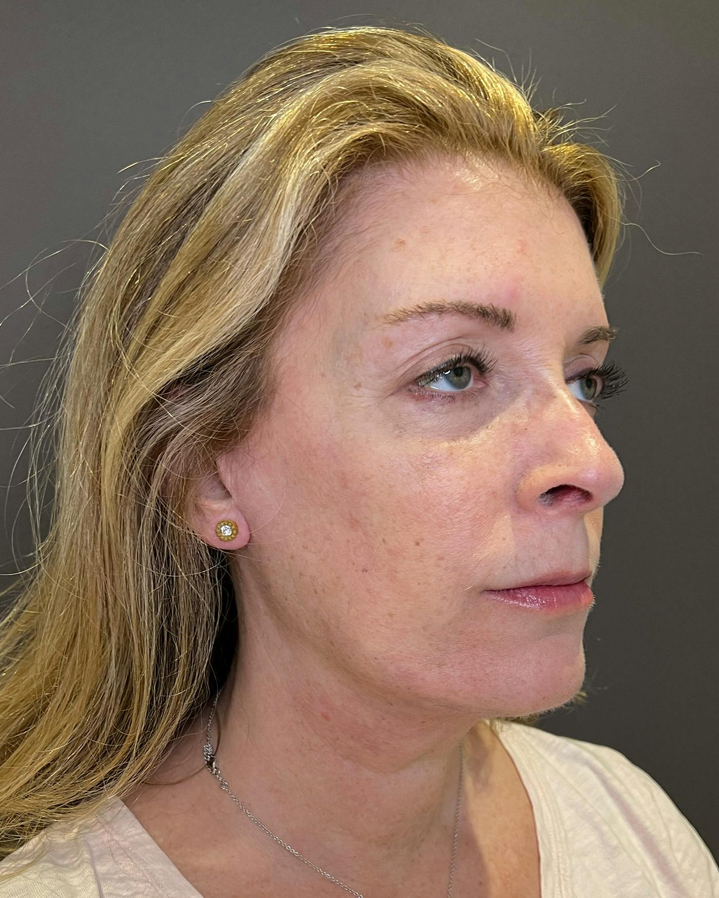 Facelifts / Necklift Before & After Gallery - Patient 830010 - Image 2