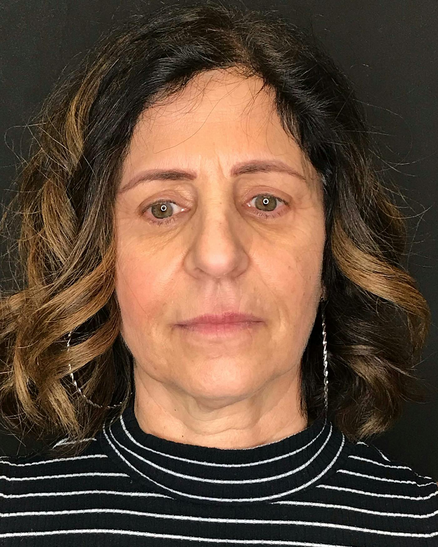 Facelifts / Necklift Before & After Gallery - Patient 208221 - Image 3