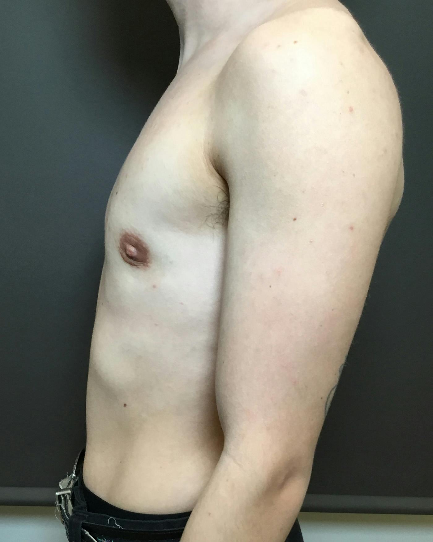 Top Surgery Before & After Gallery - Patient 149616 - Image 6