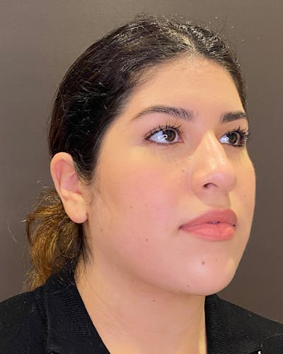 Liposuction Before & After Gallery - Patient 936804 - Image 2