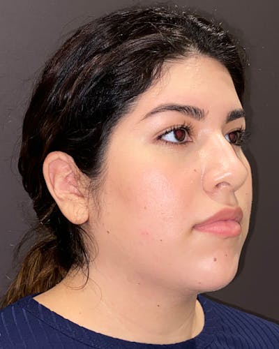 Liposuction Before & After Gallery - Patient 936804 - Image 1