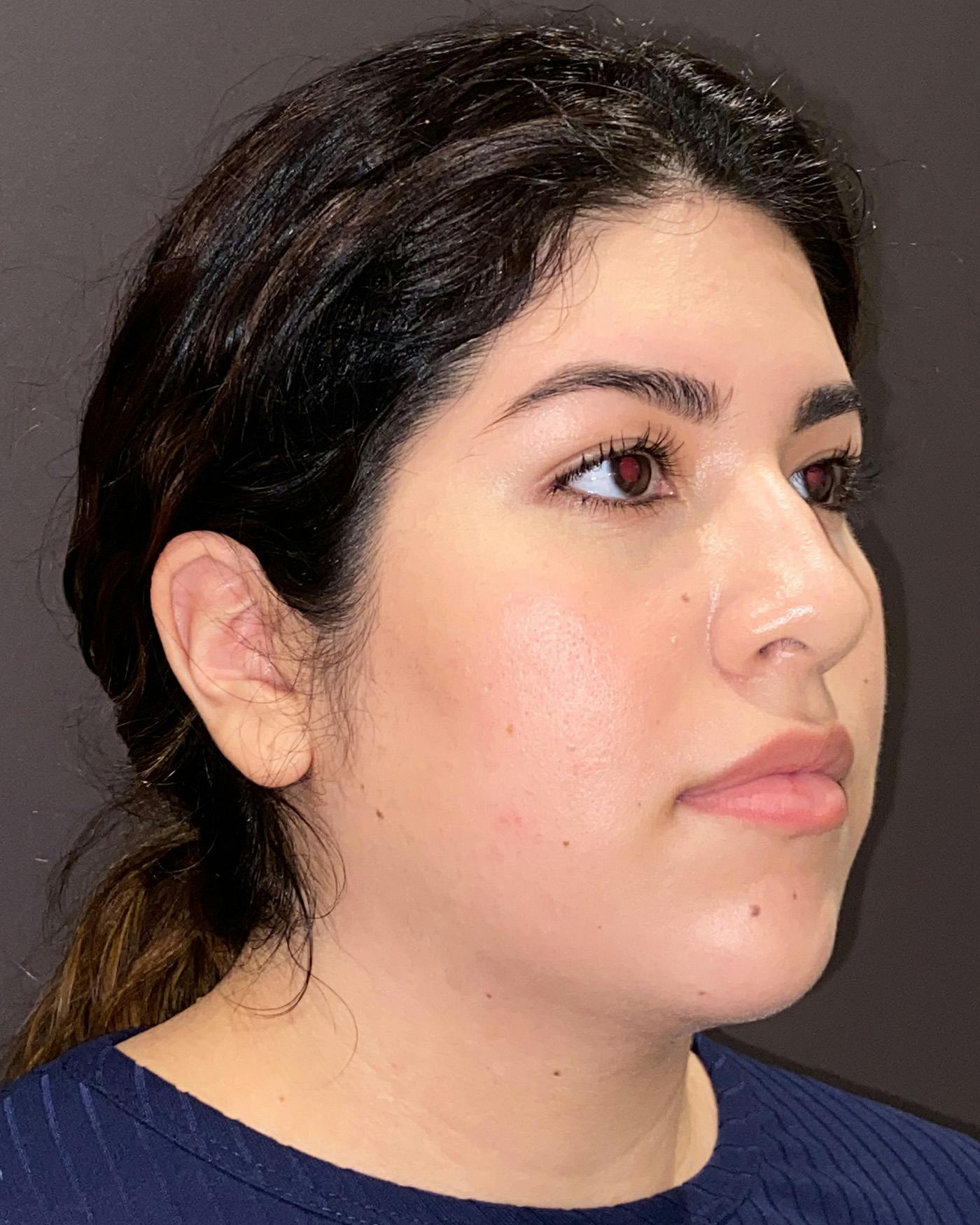 Liposuction Before & After Gallery - Patient 936804 - Image 1