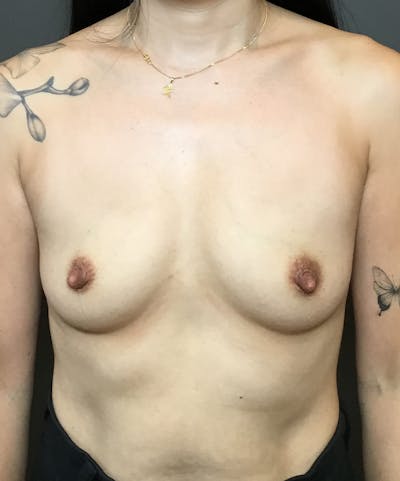 Breast Augmentation Before & After Gallery - Patient 324216 - Image 1