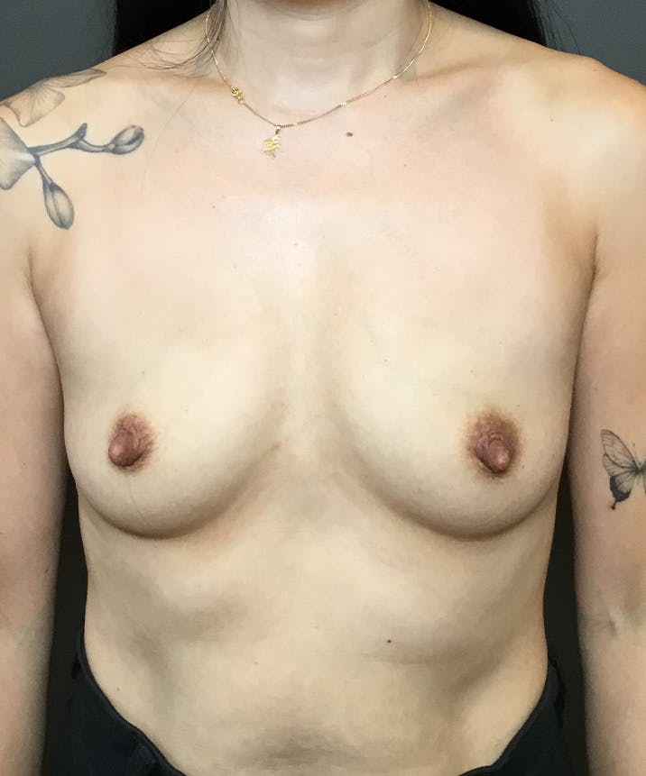 Breast Augmentation Before & After Gallery - Patient 324216 - Image 1