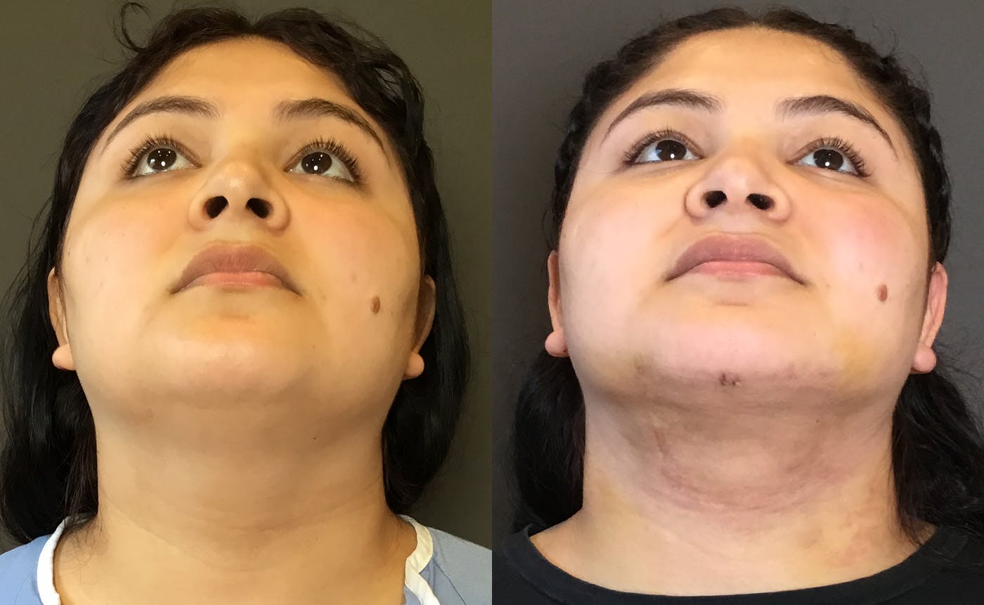 Chin Augmentation Before & After Gallery - Patient 159722 - Image 4
