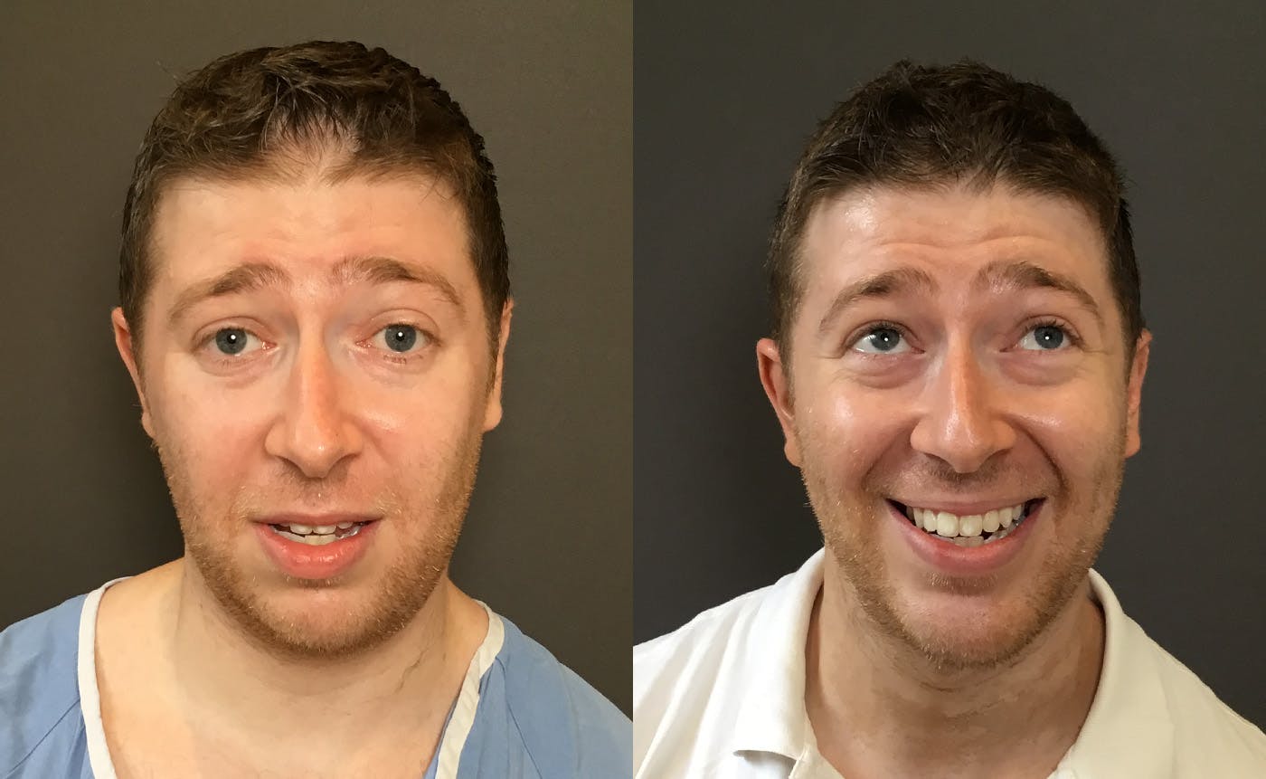 Chin Augmentation Before & After Gallery - Patient 360625 - Image 3