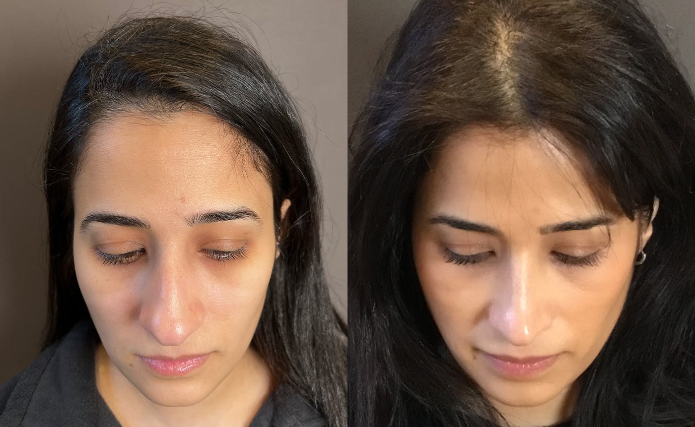 Rhinoplasty Before & After Gallery - Patient 329170 - Image 6