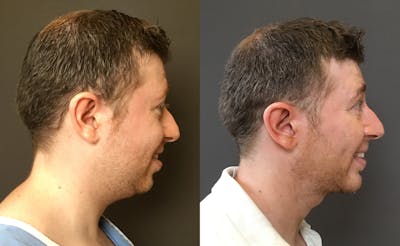 Chin Augmentation Before & After Gallery - Patient 360625 - Image 1