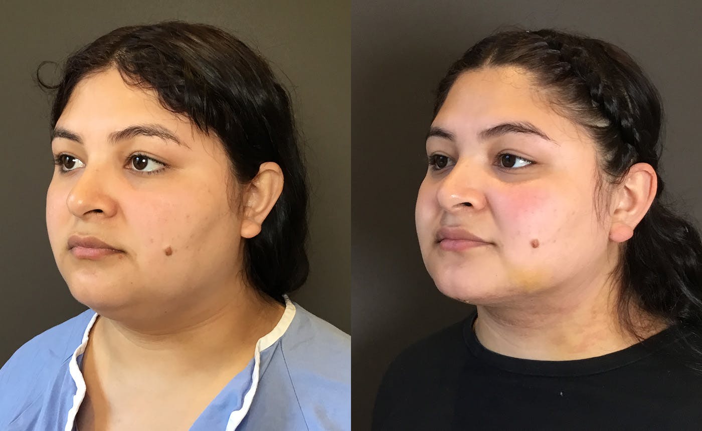 Chin Augmentation Before & After Gallery - Patient 159722 - Image 3