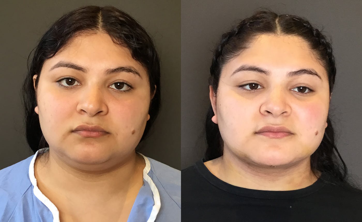 Chin Augmentation Before & After Gallery - Patient 159722 - Image 1