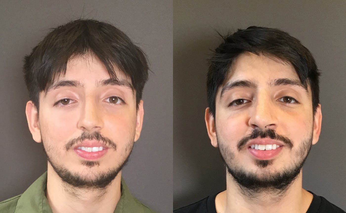 Rhinoplasty Before & After Gallery - Patient 165207 - Image 3