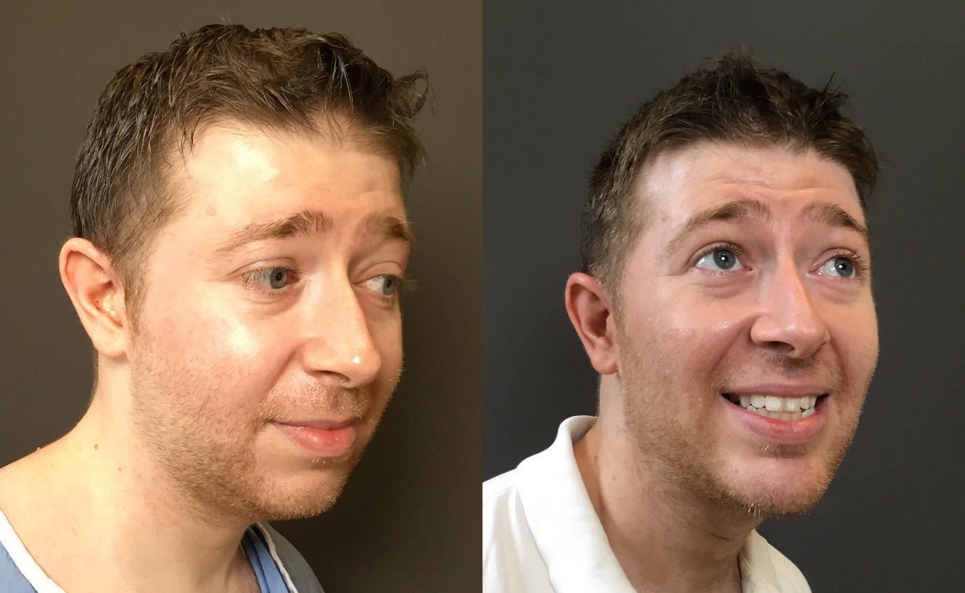 Chin Augmentation Before & After Gallery - Patient 360625 - Image 2