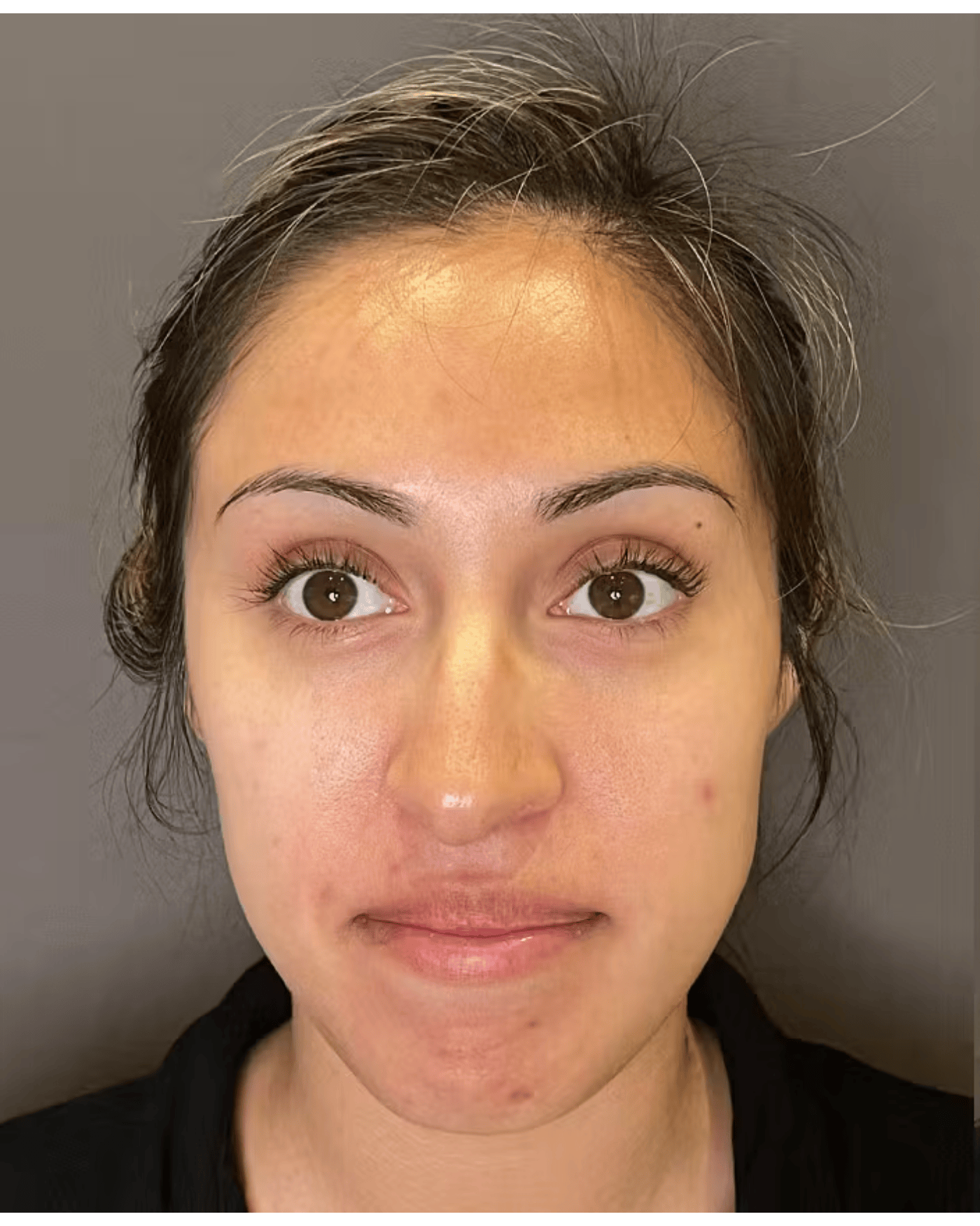 Rhinoplasty Before & After Gallery - Patient 900363 - Image 5