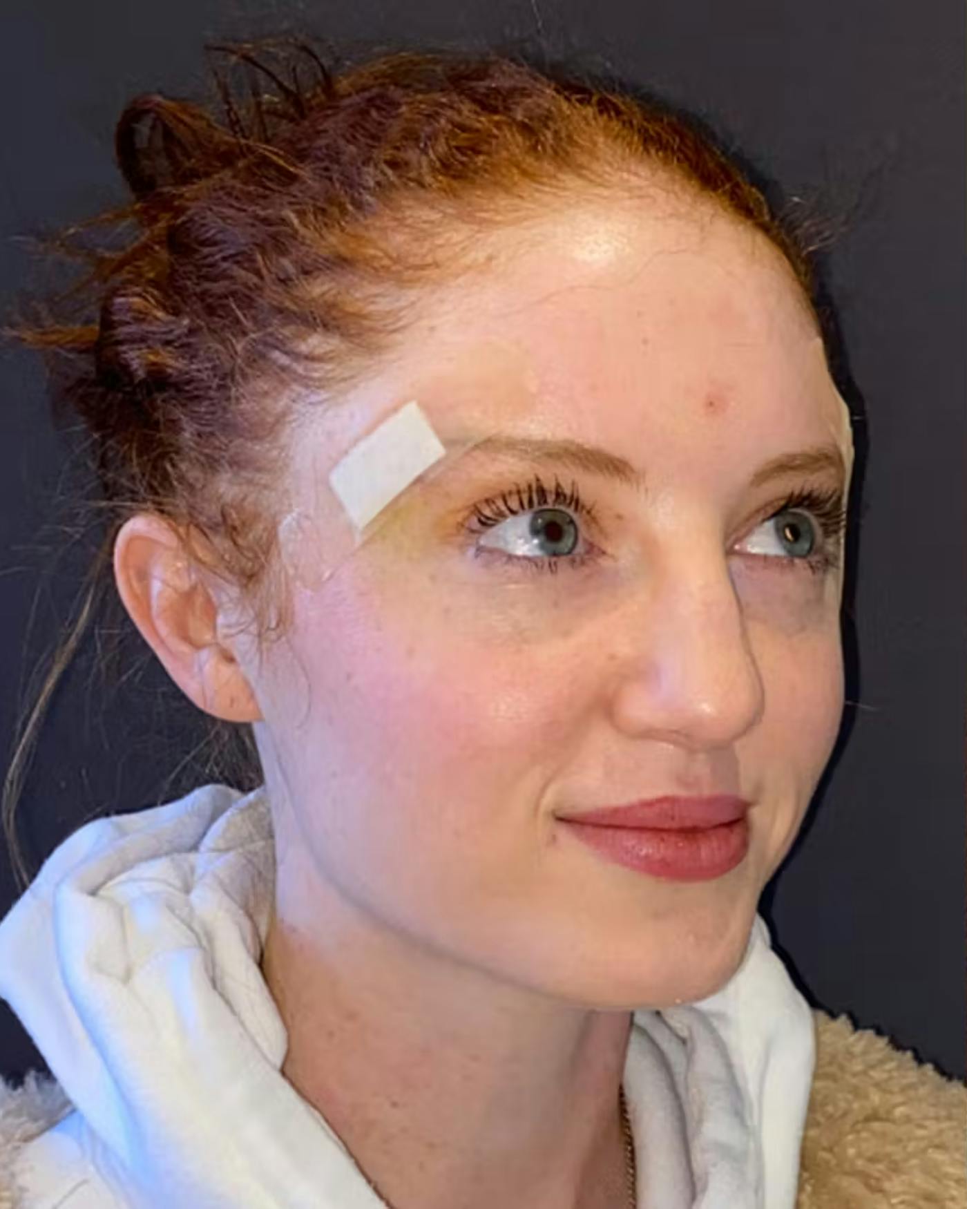 Rhinoplasty Before & After Gallery - Patient 348332 - Image 3