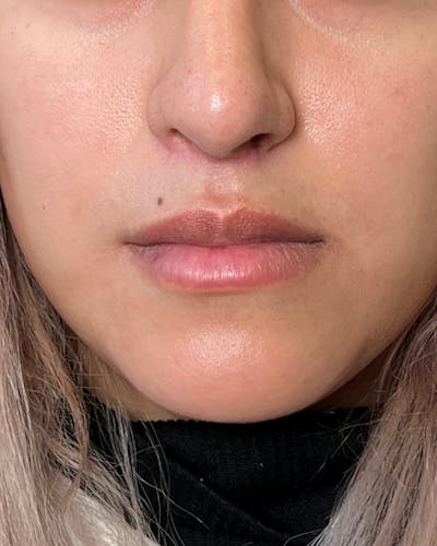 Lip Lift / Lip Reduction Before & After Gallery - Patient 310400 - Image 2