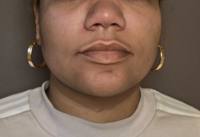 Liposuction Before & After Gallery - Patient 175992 - Image 2