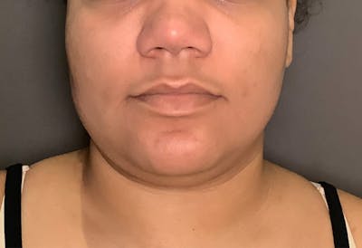 Liposuction Before & After Gallery - Patient 175992 - Image 1