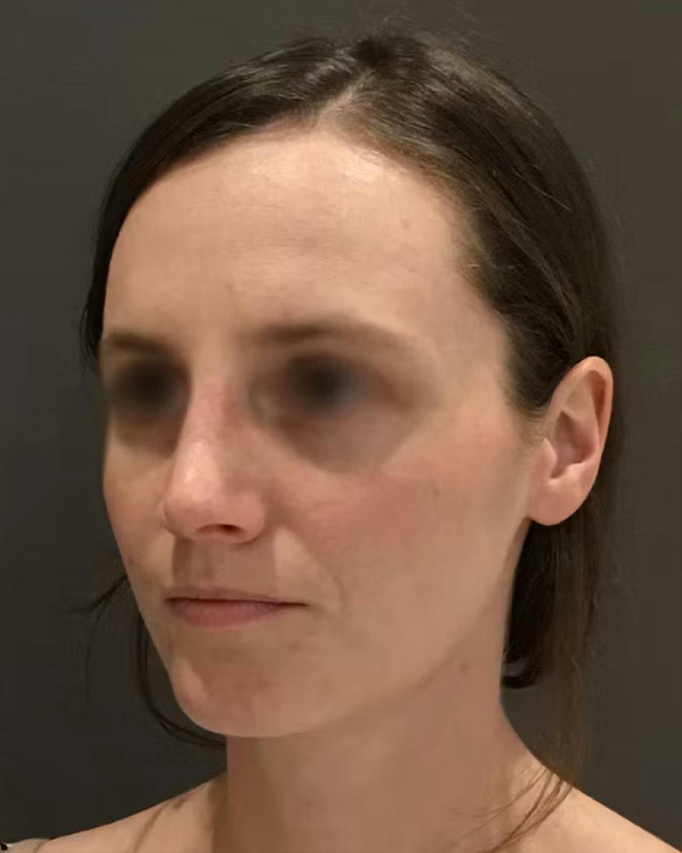 Rhinoplasty Before & After Gallery - Patient 172023 - Image 8