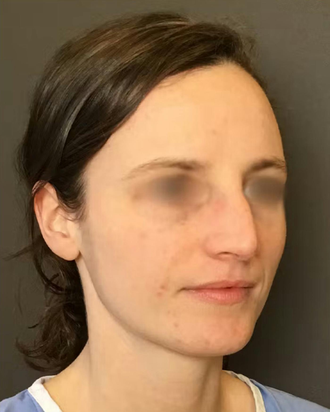 Rhinoplasty Before & After Gallery - Patient 172023 - Image 3