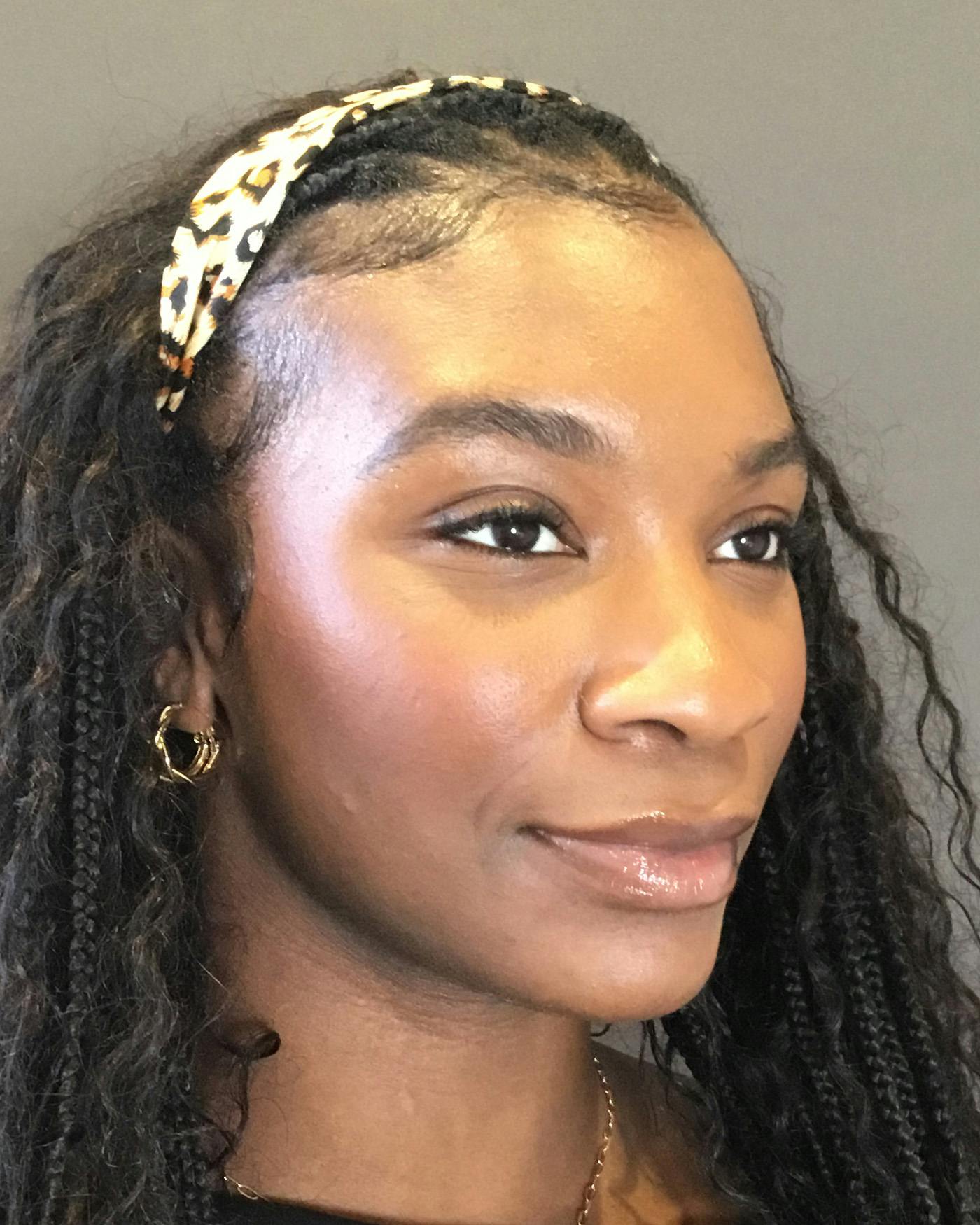 Rhinoplasty Before & After Gallery - Patient 297780 - Image 3
