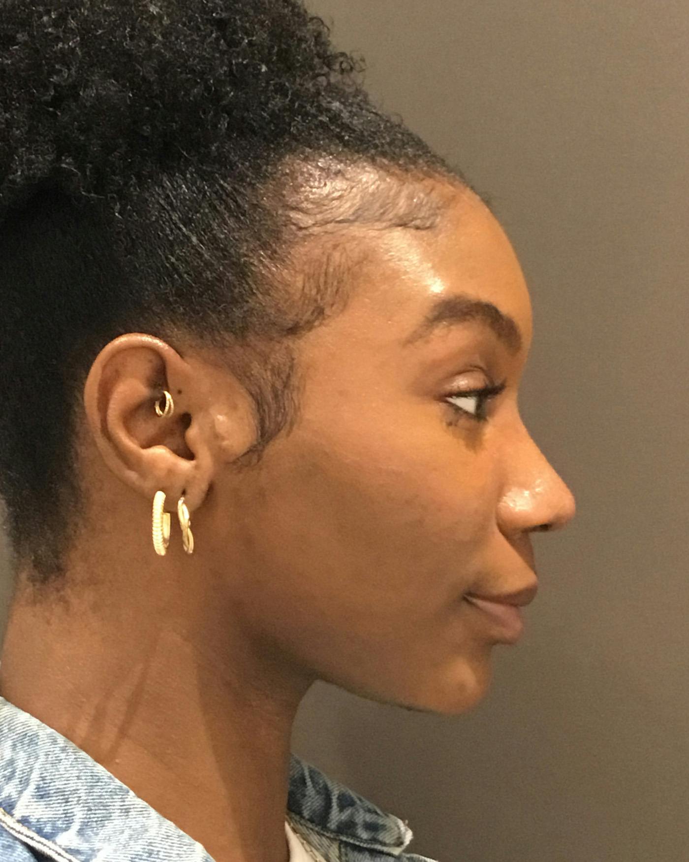 Rhinoplasty Before & After Gallery - Patient 297780 - Image 2