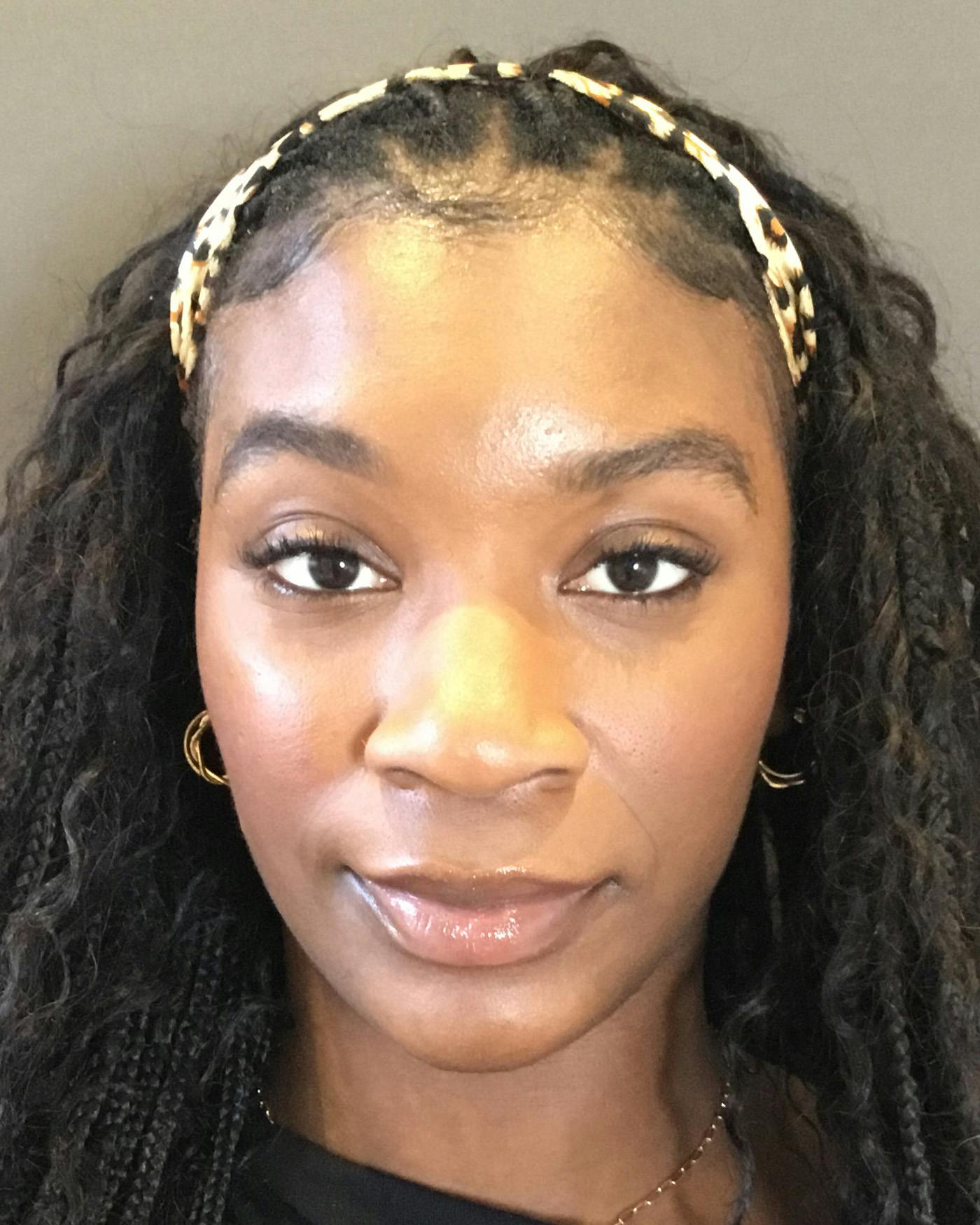 Rhinoplasty Before & After Gallery - Patient 297780 - Image 5