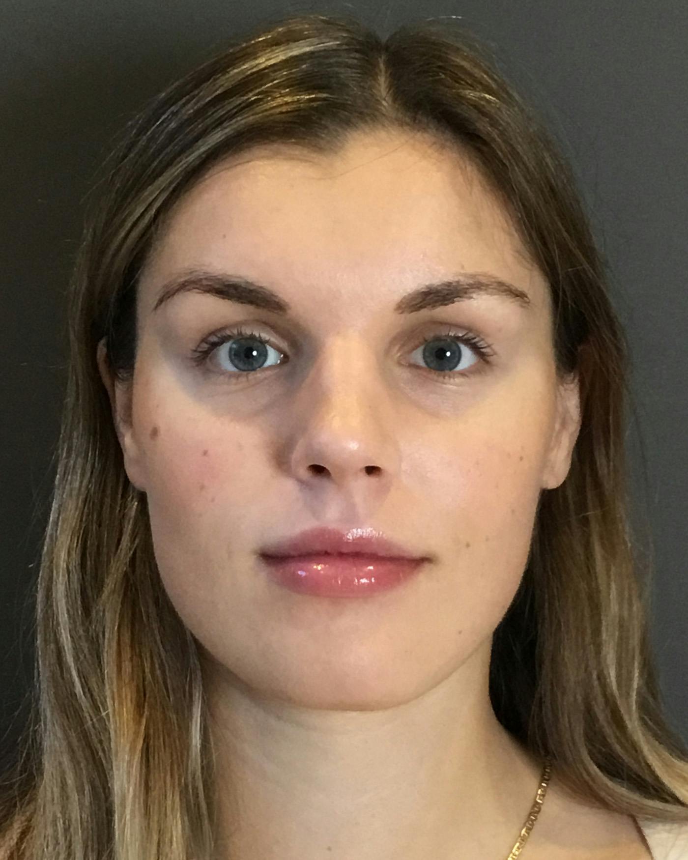 Rhinoplasty Before & After Gallery - Patient 360965 - Image 5