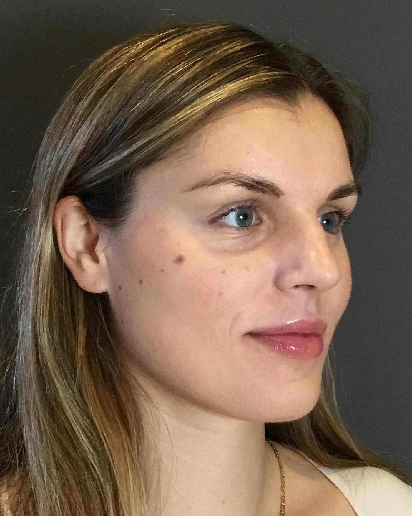 Rhinoplasty Before & After Gallery - Patient 360965 - Image 3