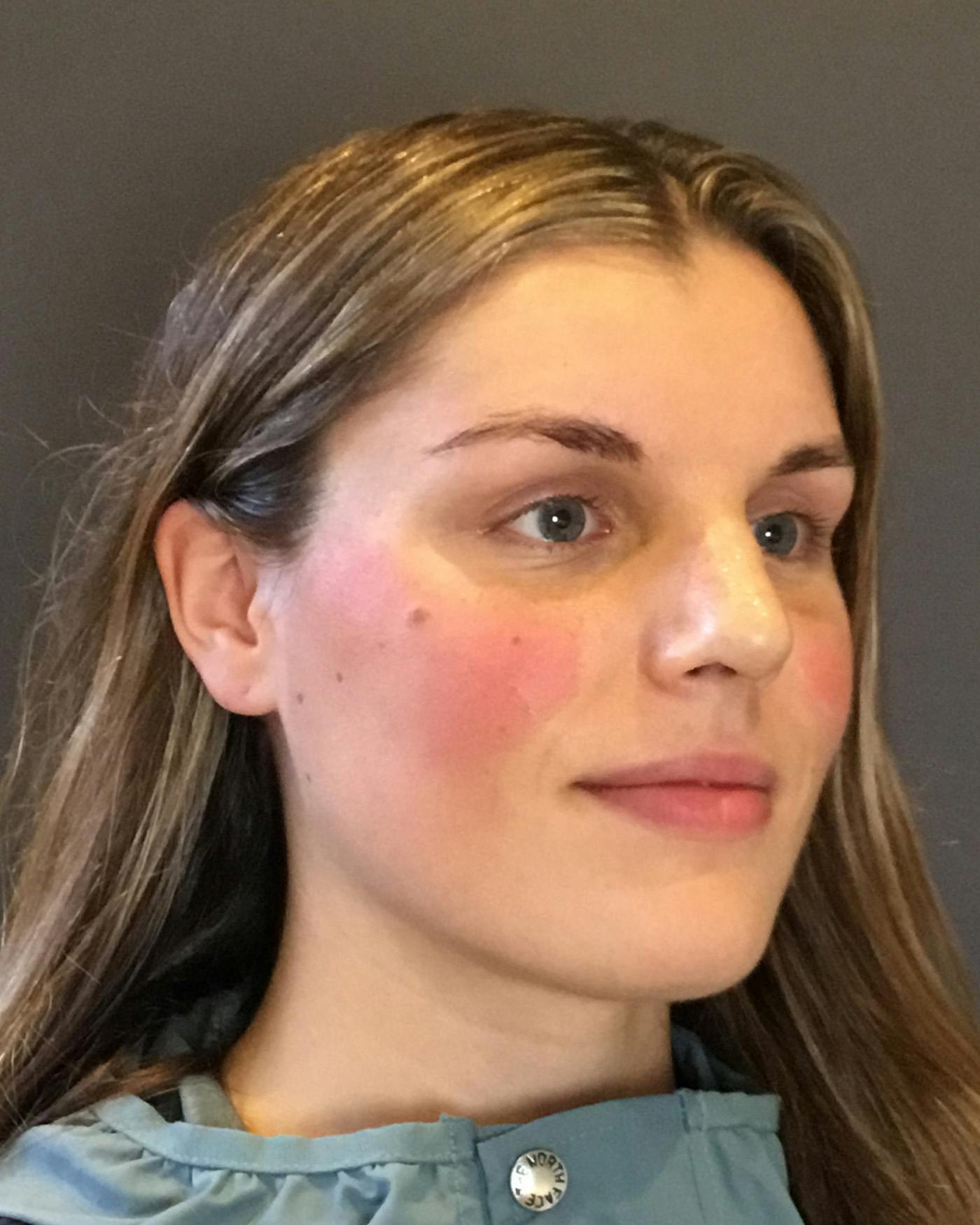 Rhinoplasty Before & After Gallery - Patient 360965 - Image 4