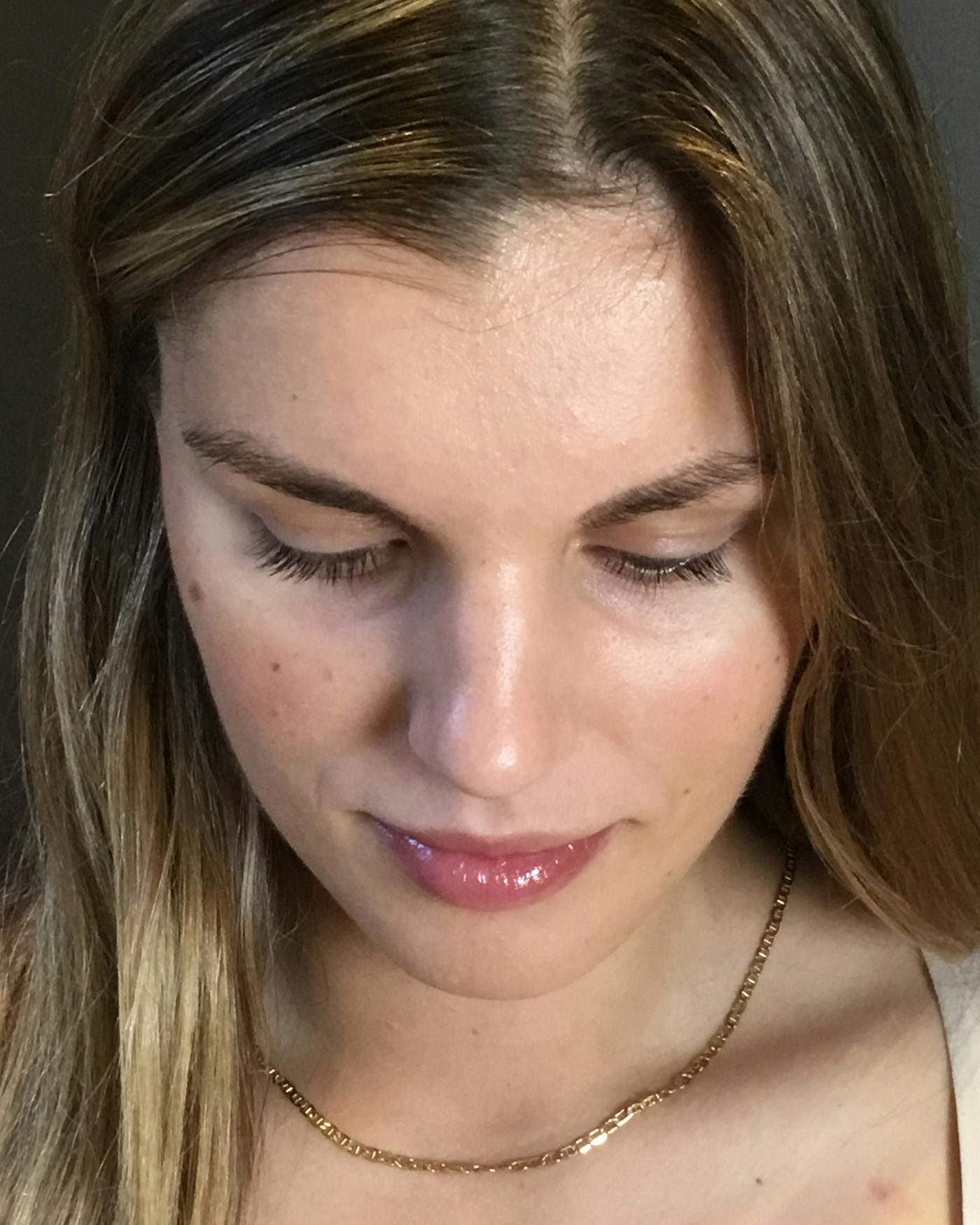 Rhinoplasty Before & After Gallery - Patient 360965 - Image 11