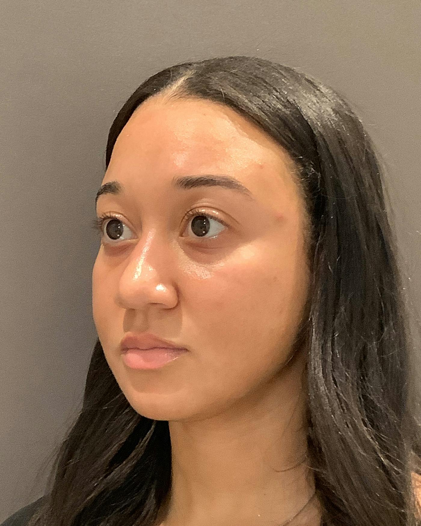 Rhinoplasty Before & After Gallery - Patient 299150 - Image 7