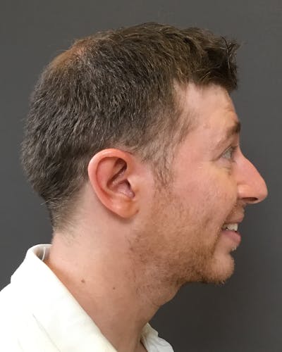 Liposuction Before & After Gallery - Patient 145013 - Image 1