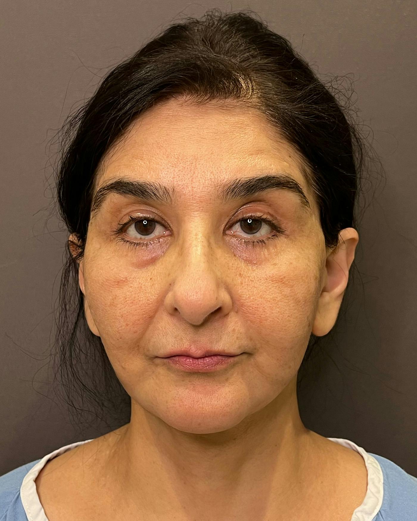 Facelifts / Necklift Before & After Gallery - Patient 190626 - Image 4