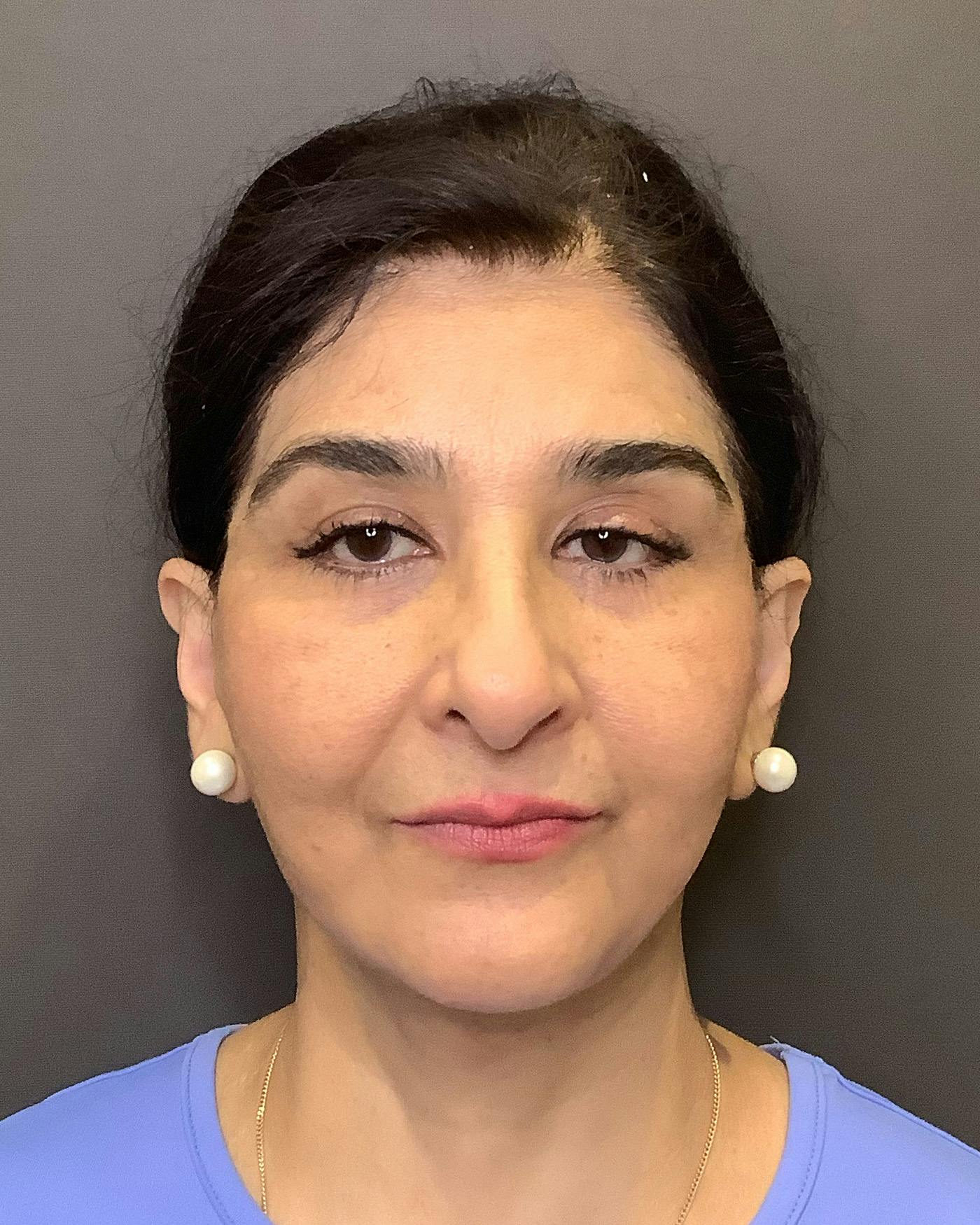 Facelifts / Necklift Before & After Gallery - Patient 190626 - Image 3