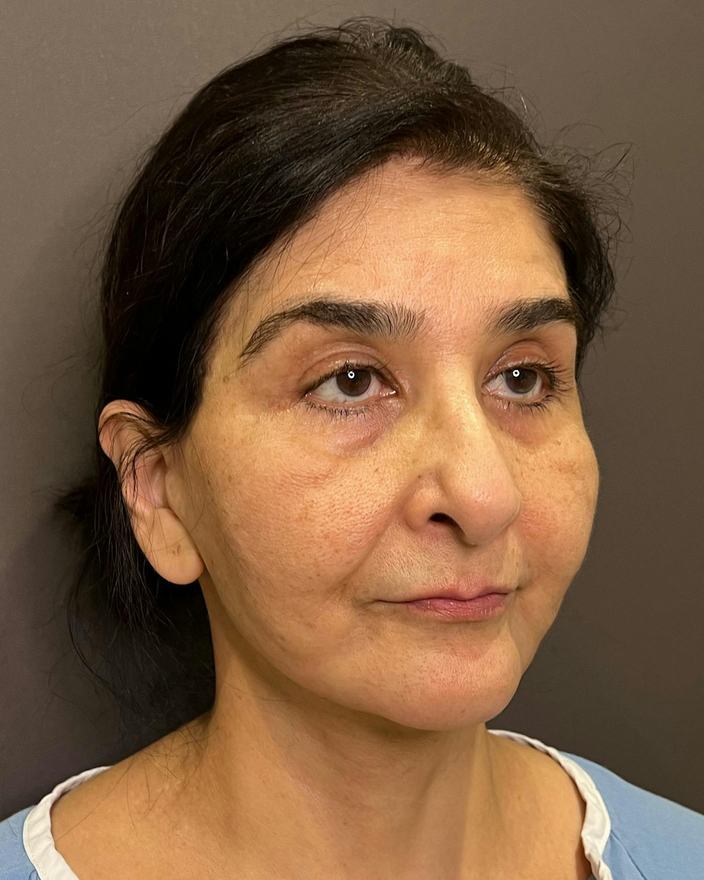Facelifts / Necklift Before & After Gallery - Patient 190626 - Image 1