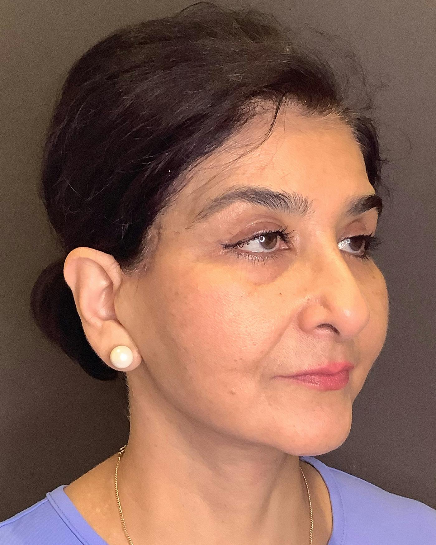 Facelifts / Necklift Before & After Gallery - Patient 190626 - Image 2