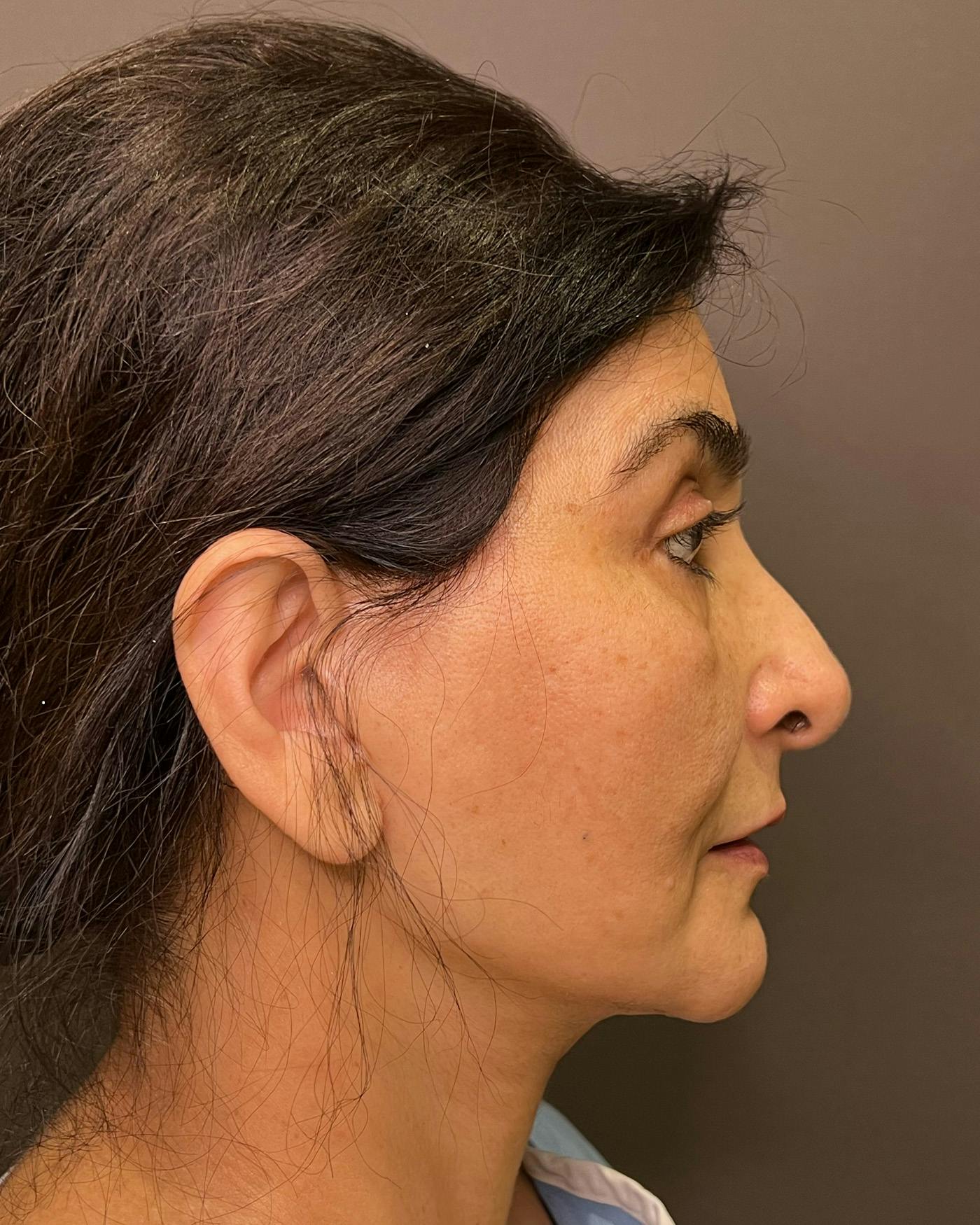 Facelifts / Necklift Before & After Gallery - Patient 190626 - Image 7